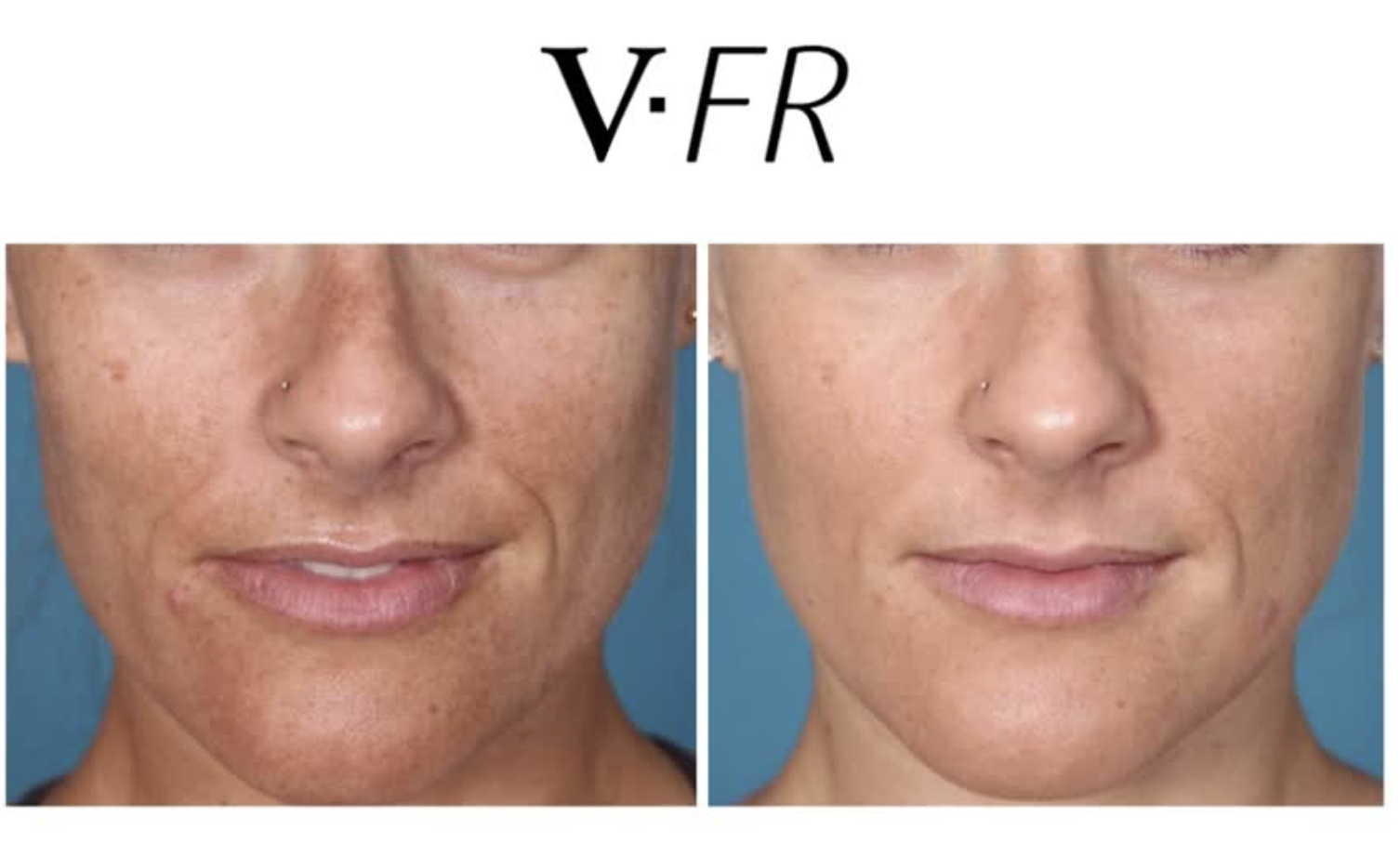 Side-by-side comparison photo showing a woman's face before and after skincare treatment, labeled V·FR at the top.
