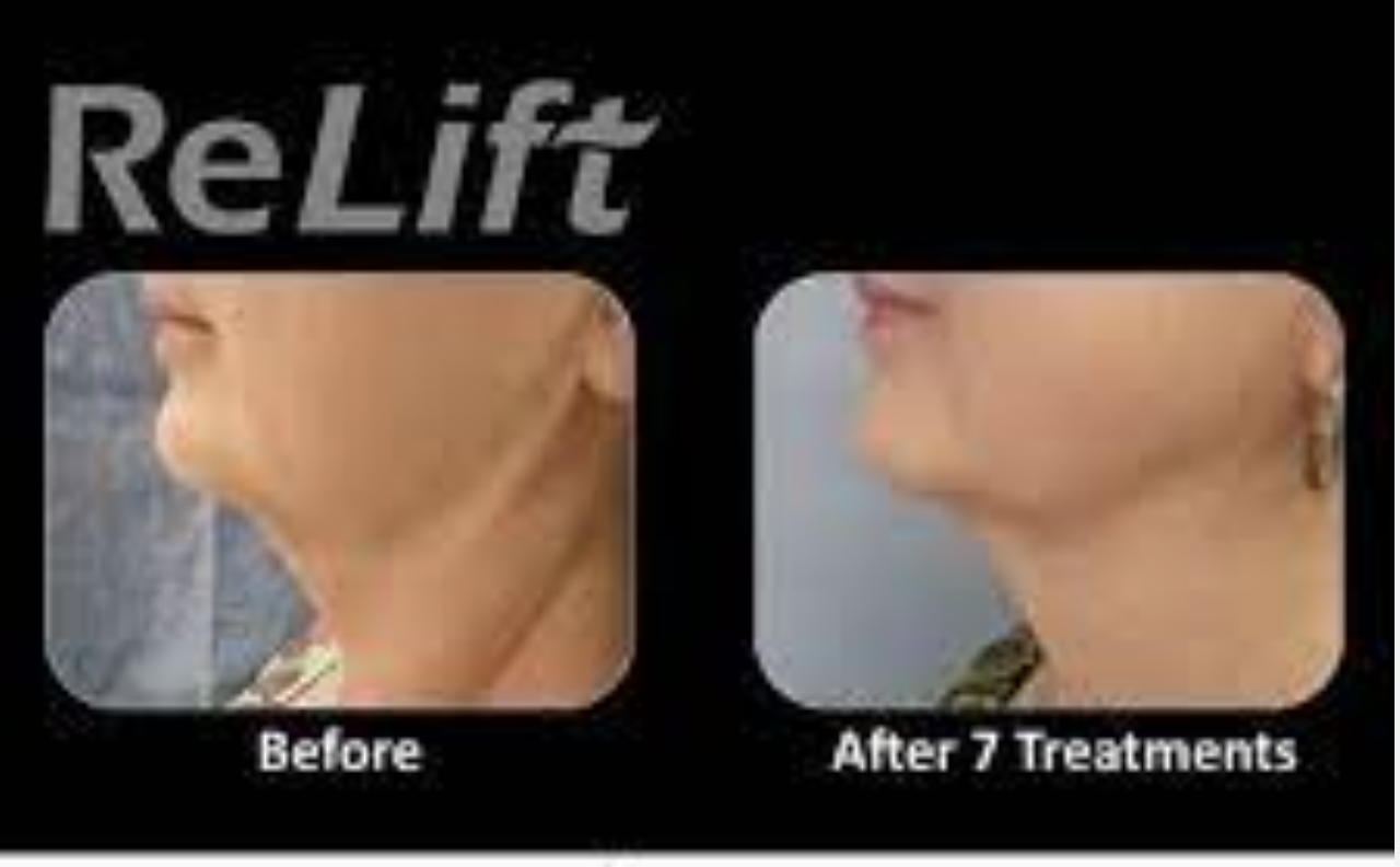 Side-by-side comparison of a person's neck and jawline showing the skin before and after 7 treatments, with the left labeled 'Before' and the right labeled 'After 7 Treatments'.