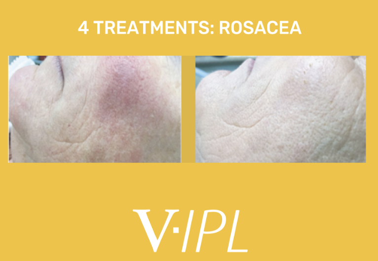 Comparison of skin before and after 4 rosacea treatments, showing reduced redness and improved skin texture.