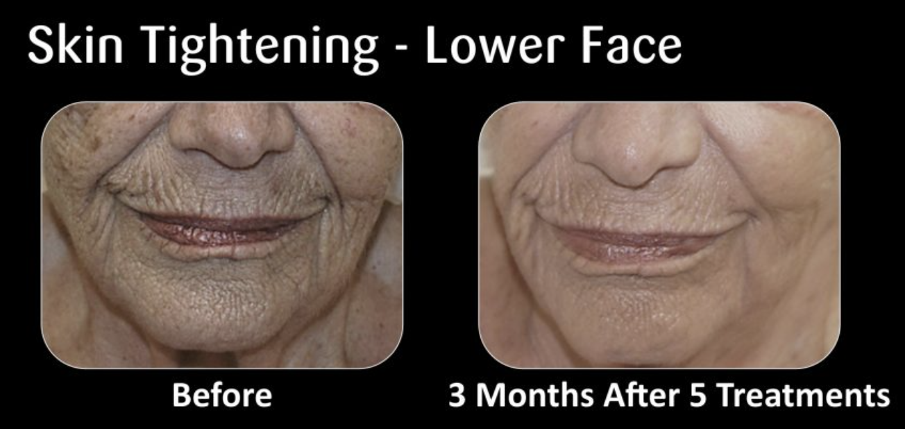 Comparison of lower face skin before and after 3 months of skin tightening treatment, showing reduced wrinkles and smoother skin.