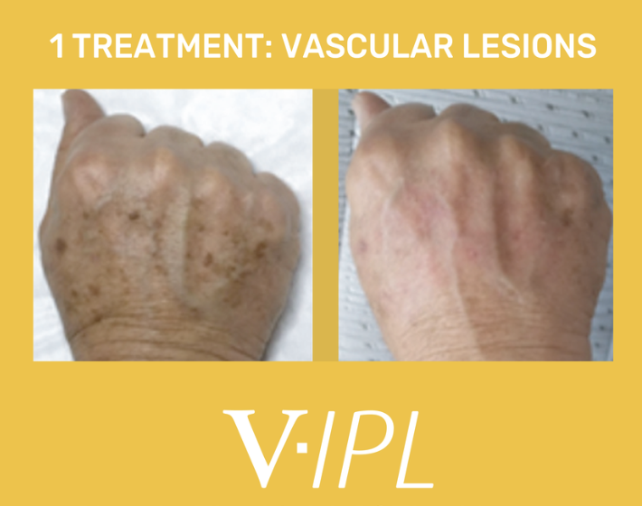Comparison of hand with vascular lesions before and after treatment. Left side shows hand with multiple brownish spots, right side shows hand with fewer spots and clearer skin. Highlighted as part of vascular lesion treatment promotion.