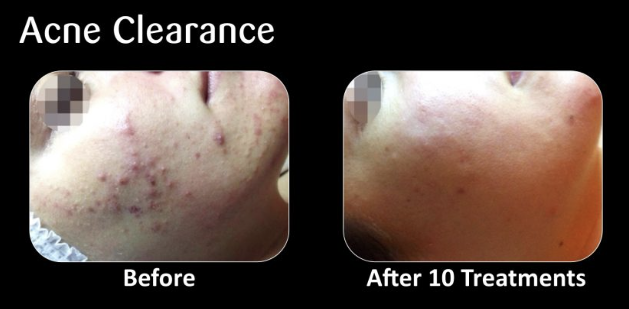 Side-by-side comparison photo showing the chin and cheek area of a person before and after 10 acne treatments. The 'before' image shows red, inflamed acne with numerous pimples, while the 'after' image shows clearer skin with significantly fewer pimp