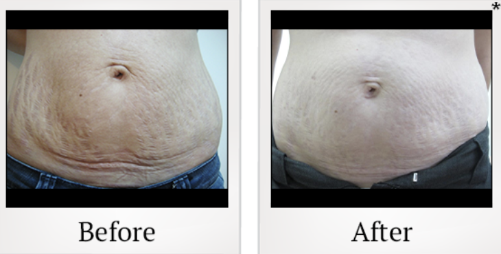 Side-by-side comparison of a belly before and after treatment. The before image shows loose, wrinkled skin, while the after image shows smoother skin with reduced wrinkles.