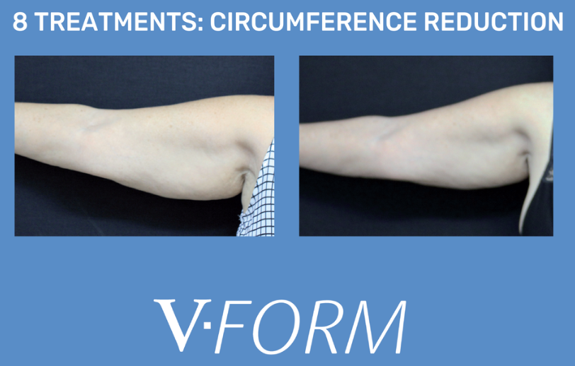 Before and after images showing a reduction in arm circumference as part of V-Form treatment, with text indicating 8 treatments for circumference reduction.