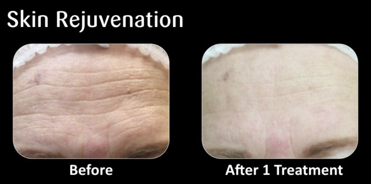 Comparison of forehead skin before and after skin rejuvenation treatment showing reduced wrinkles and smoother skin after one session.
