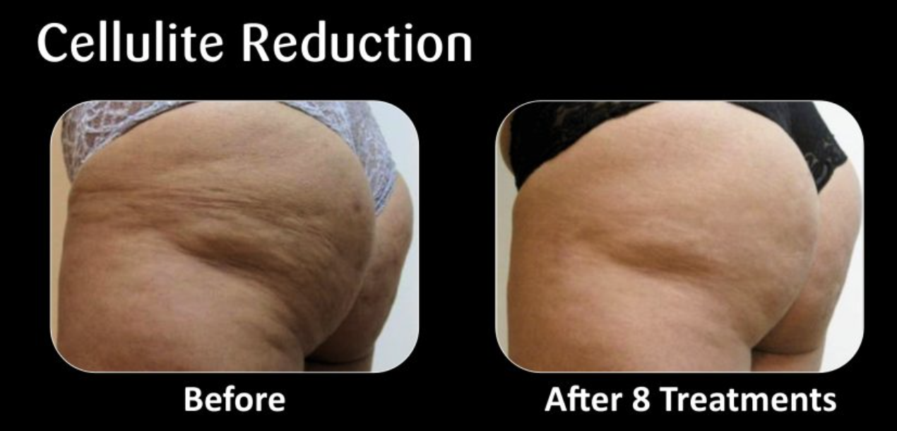 Comparison of a person's buttocks before and after 8 cellulite reduction treatments, showing less cellulite and smoother skin in the after image.