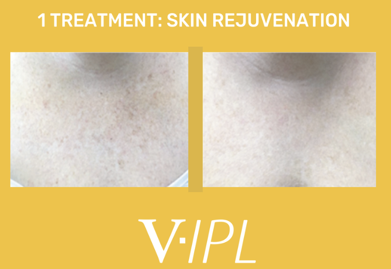 Comparison of skin before and after treatment showing skin rejuvenation, with the caption '1 Treatment: Skin Rejuvenation' and the brand name 'VIPL'.