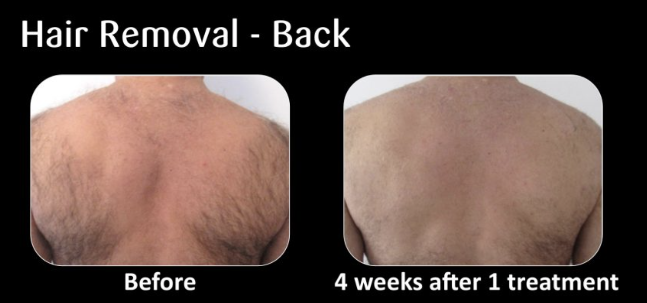 Comparison image showing back hair removal results, with a 'Before' picture of hairy back and a '4 weeks after 1 treatment' picture of less hairy back.