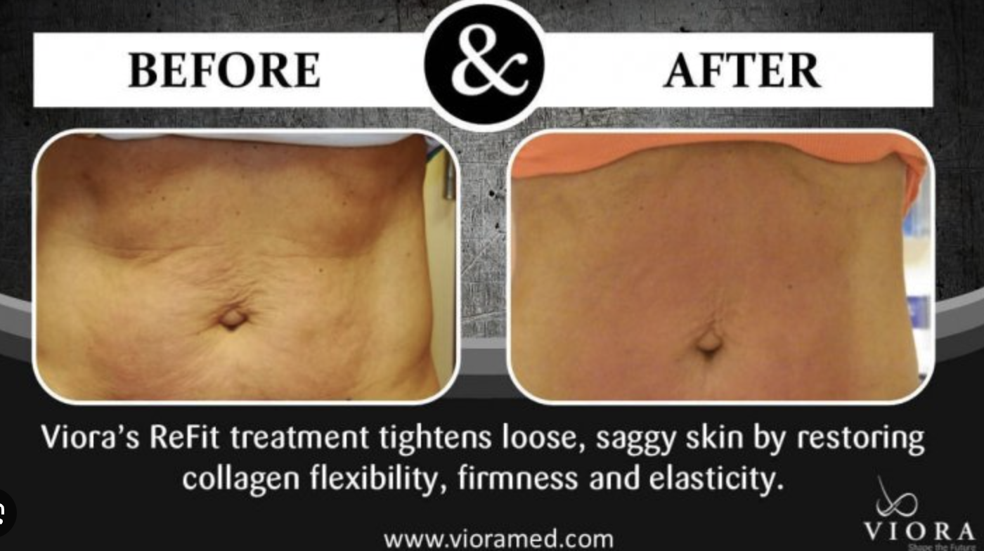 Comparison of a person's abdomen before and after a ReFit treatment showing tightened, smoother skin.