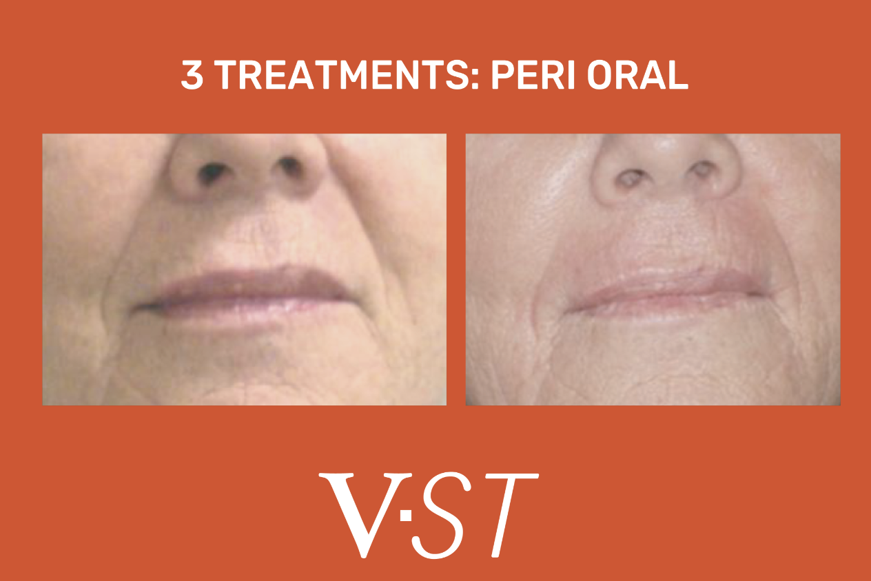 Comparison of facial appearance before and after three treatments of peri oral VST, showing smoother skin around the mouth and reduced signs of aging.