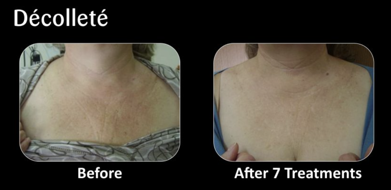 Comparison of a woman's chest before and after seven treatments, showing reduced skin redness and improved skin appearance.