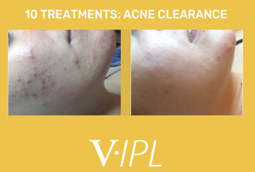 Comparison of a person's chin showing acne before and after 10 treatments for acne clearance, with the skin appearing clearer and less inflamed in the after photo.