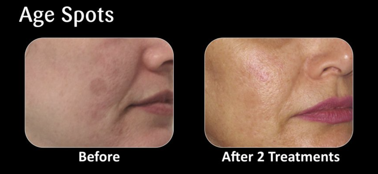 Comparison of a woman's face showing age spots before and after two treatments, with clearer skin in the after image.