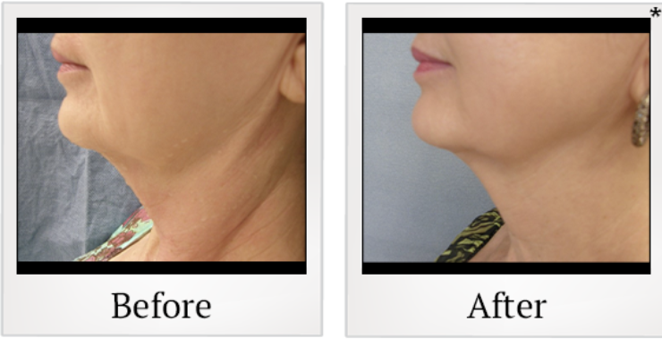 Side-by-side comparison of a woman's neck and jawline before and after treatment, showing improved skin appearance and reduced sagging.