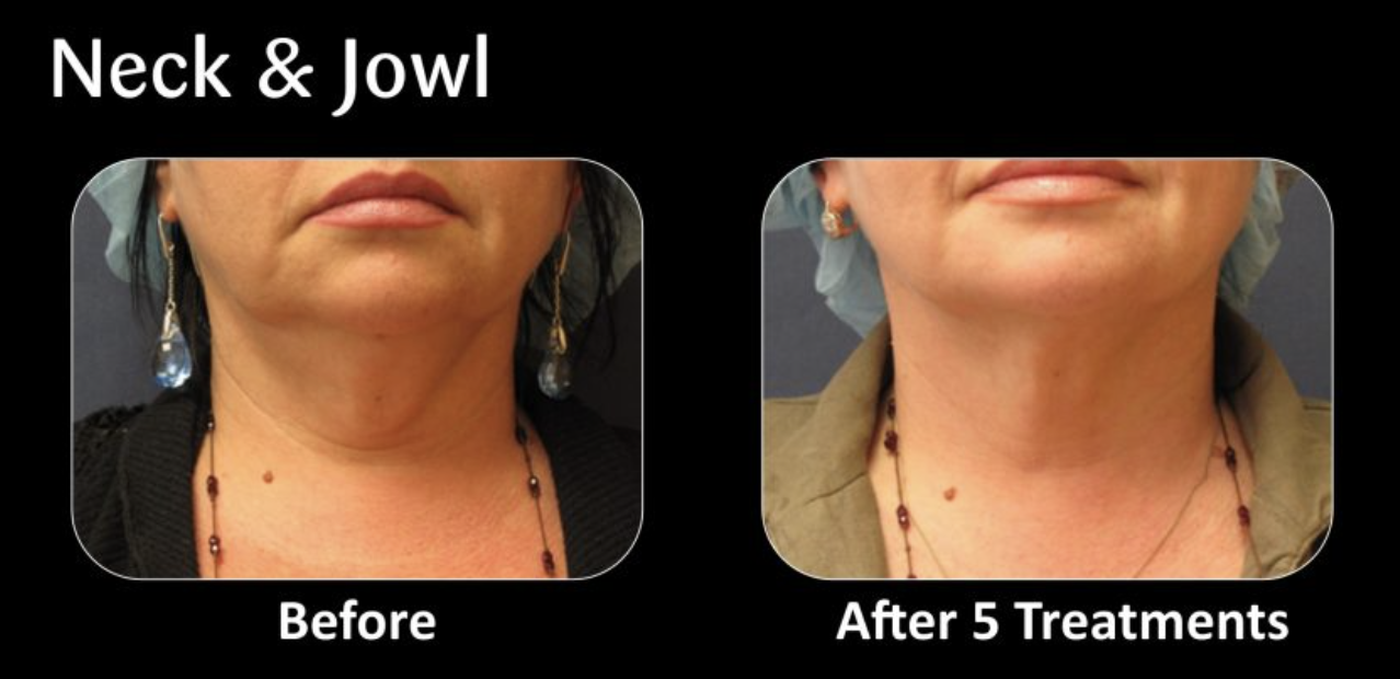Comparison of a woman's neck and jawline before and after five treatments, showing reduced sagging and improved skin appearance.
