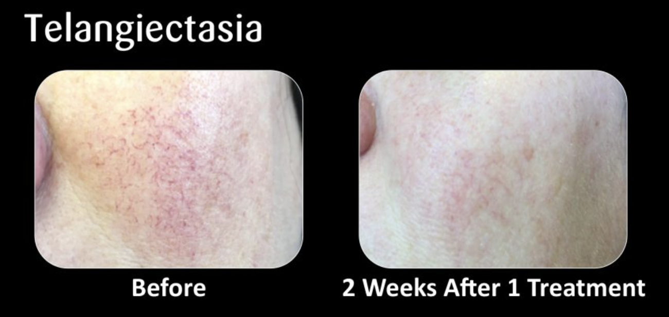 Comparison of skin with telangiectasia before and after treatment, showing reduced redness and visible blood vessels after two weeks.