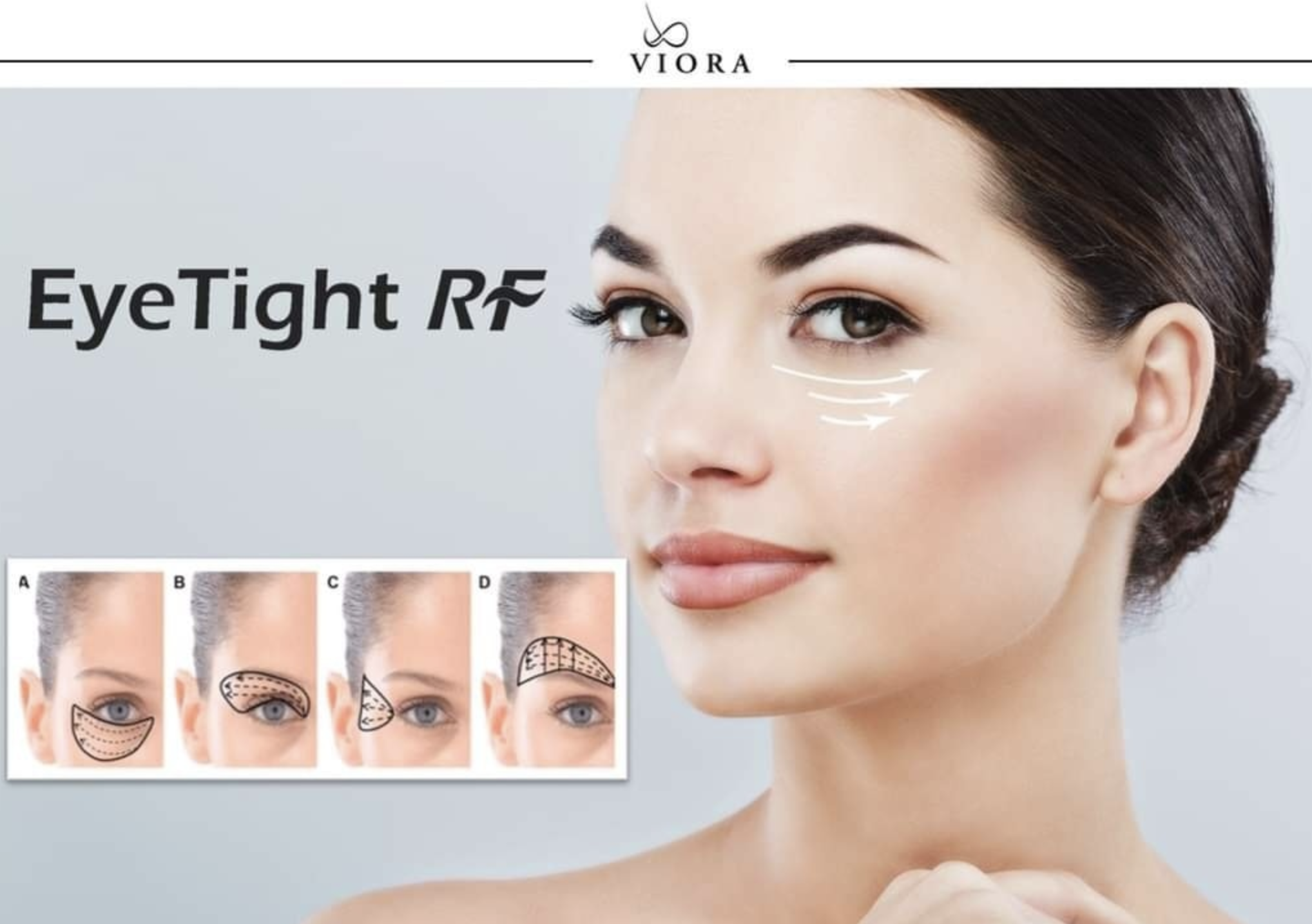 Close-up of a woman's face demonstrating an eye lift procedure, with diagrams showing different facial areas for treatment. The text reads 'Viora EyeTight RF'.