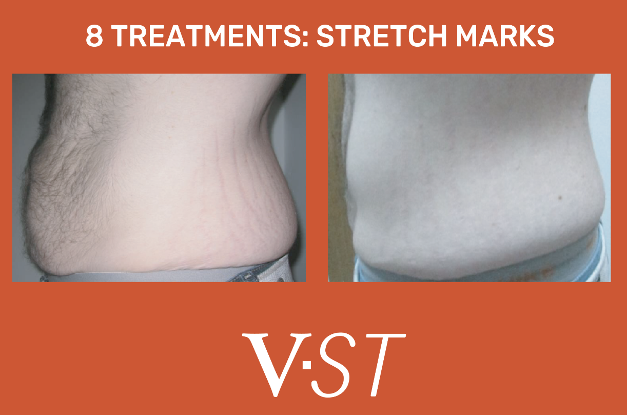 Comparison of two abdomen images showing stretch marks before and after treatment, with the text '8 Treatments: Stretch Marks' at the top and 'VST' at the bottom.