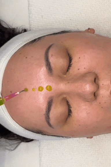 Studio Varuni Chemical Peels