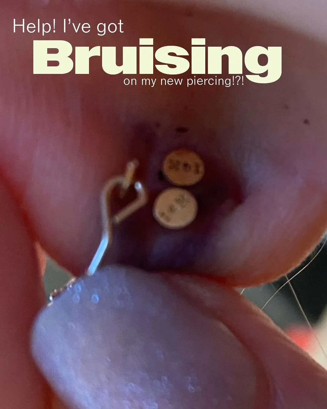 Ok, so you’ve got your new piercing and you think it’s going to be healed in like 5 minutes. But the reality is that bruising can be normal. Bruises are caused by blood leaking from broken vessels and the blood then pools under the skin.
