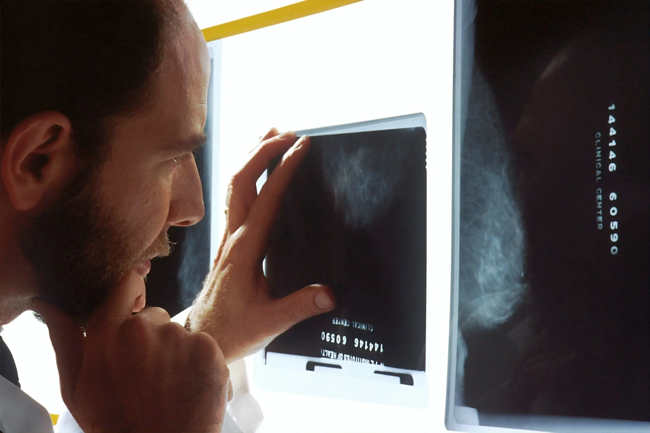 PSA Tests Explained: Should You Get Tested for Prostate Cancer?