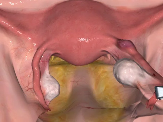 Gravidanza ectopica.jpg