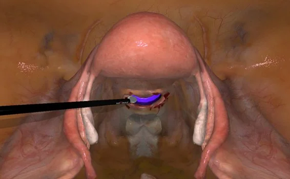 LAP-Hyst-Colpotomy.jpg