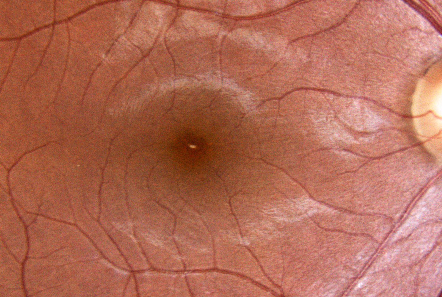 image of a normal macula seen through a microscope