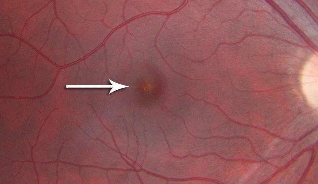 image of a macula with solar maculopathy seen through a microscope