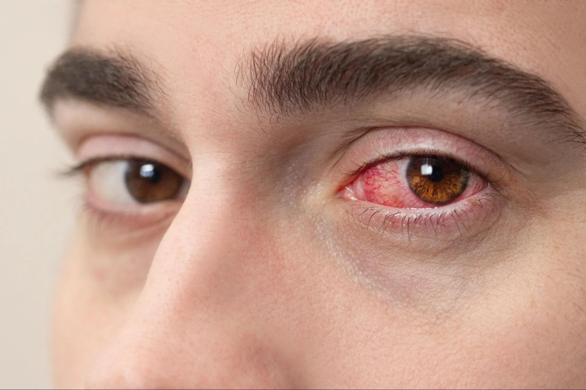 picture of a man looking at the camera with one very red, irritated eye