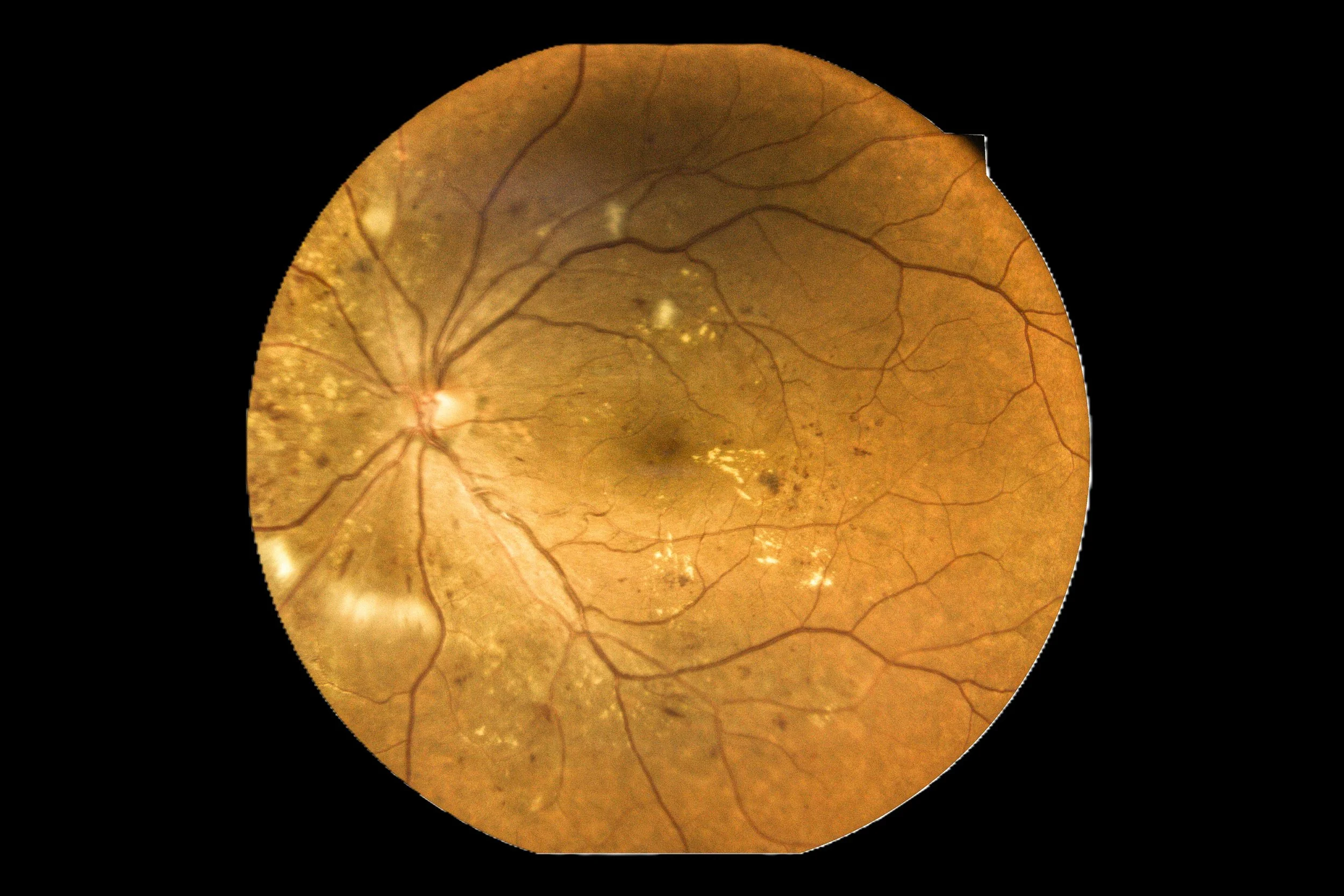 Retinal image showing the optic disc, blood vessels, and areas of pigment changes in the retina | Dr. Robert Meade | Public Speaker & Vision Consultant | Presentations about Eyes and Vision