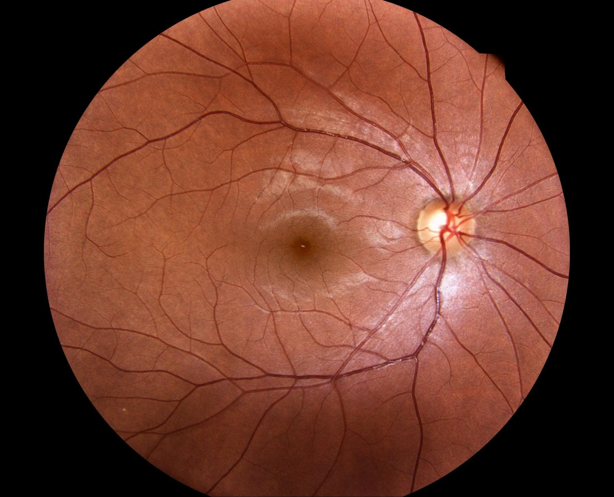 a retina through an ophthalmoscope