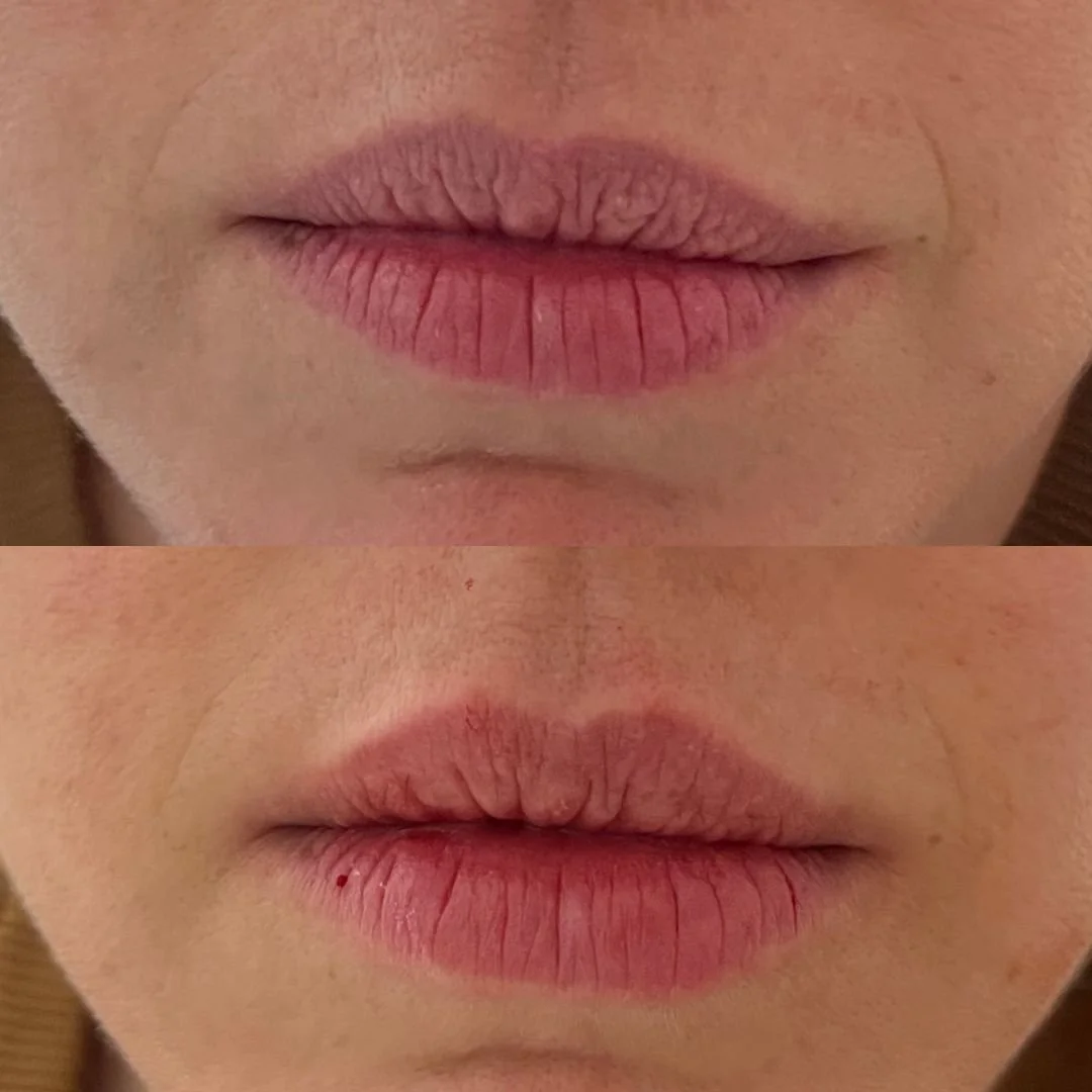 עיצוב ועיבוי שפתיים בחומצה היאלורונית לפני ואחרי – ד"ר ענת פאלון ירושלים