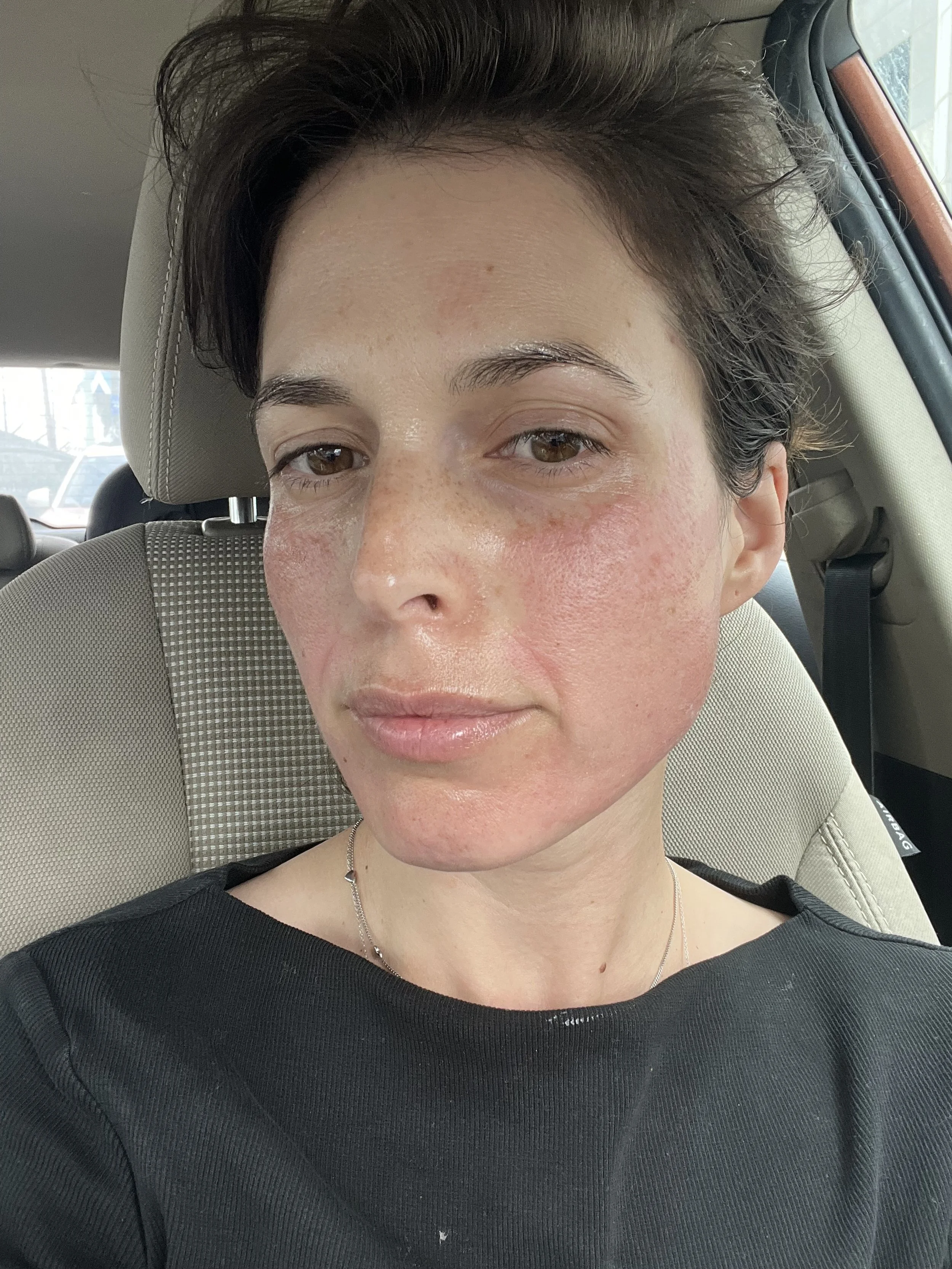 תוצאת טיפול מורפיאוס 8 לפני ואחרי למיצוק עור הפנים – ד"ר ענת פאלון