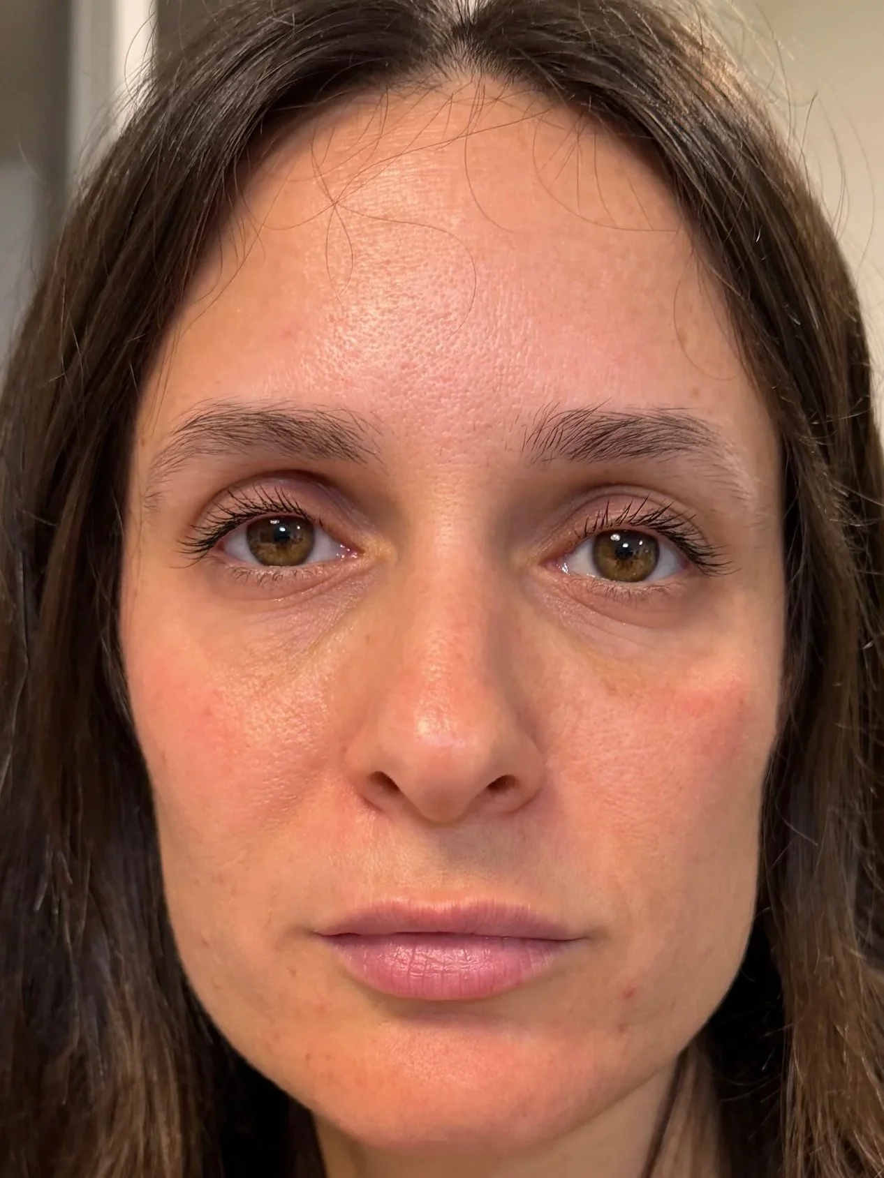 תוצאה סופית של החלקת קמטים בבוטוקס לאחר שבועיים - עור חלק וטבעי