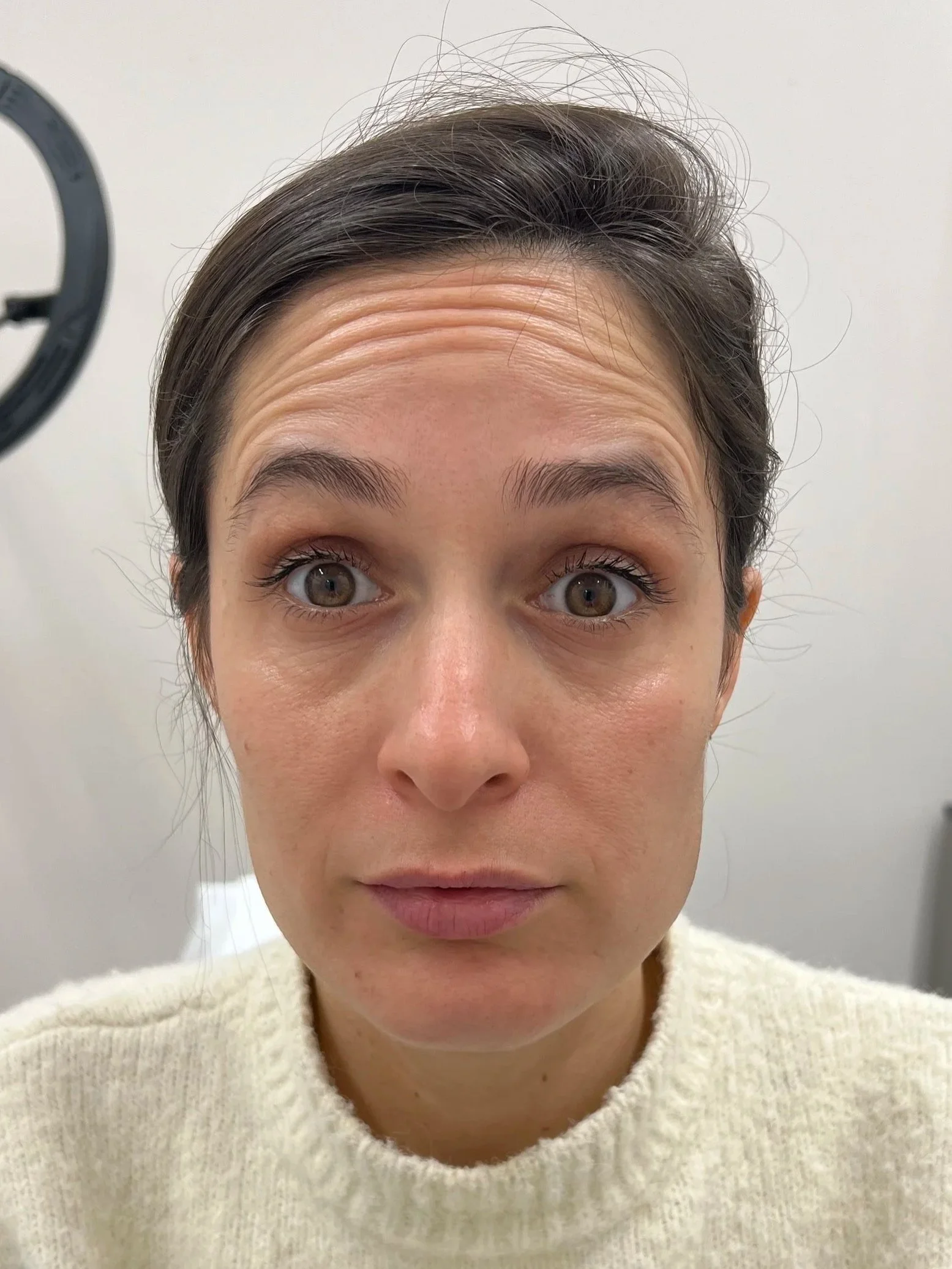 מראה קמטי מצח לפני הזרקת בוטוקס - מרפאת אסתטיקה בירושלים