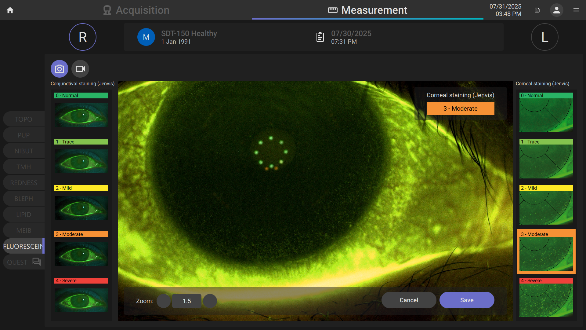 Close-up of an eye under a fluorescein dye test showing the cornea, with a color-coded grading of eye health indicating moderate staining.