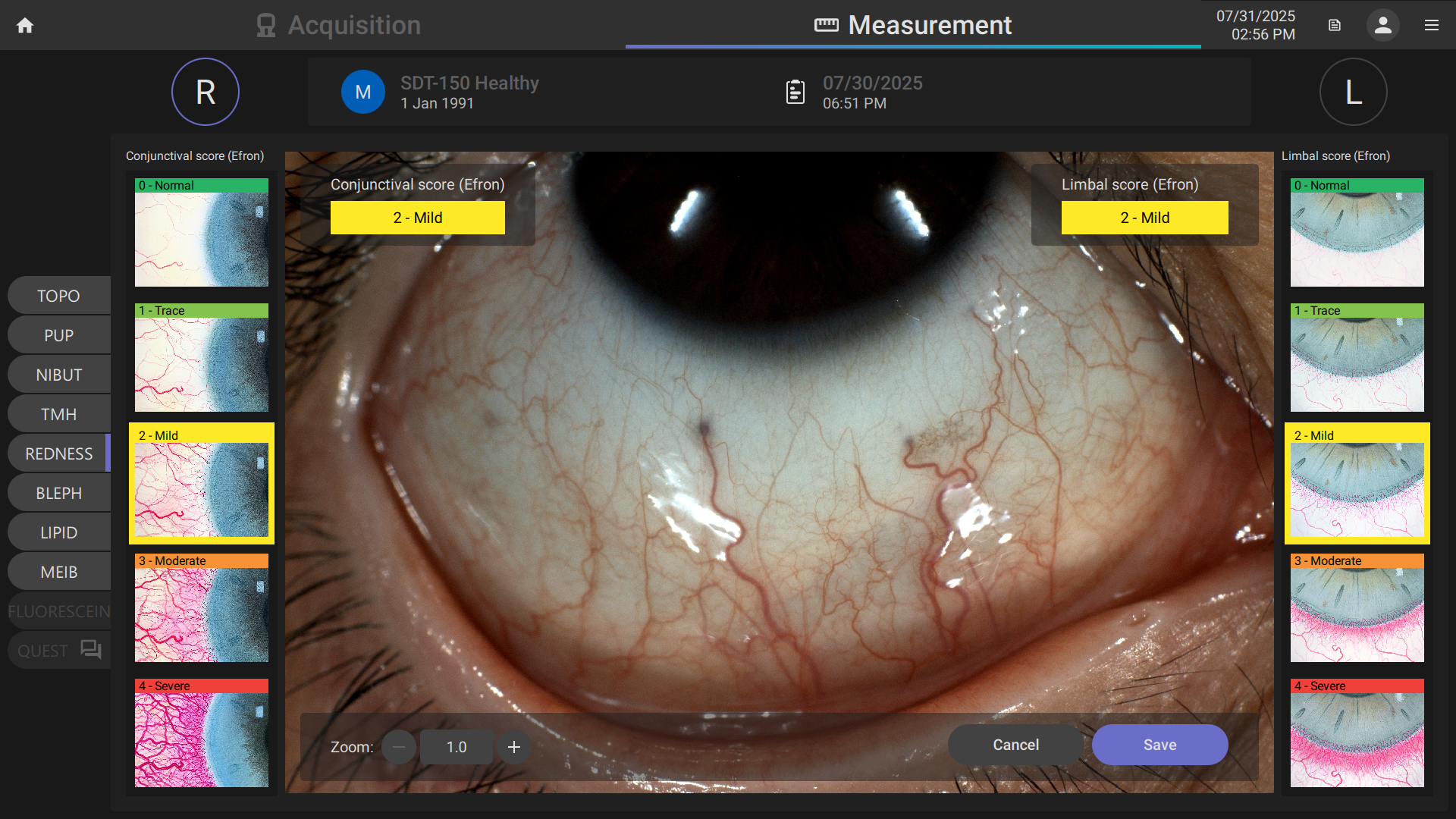 Close-up view of an eye with measurement interface, showing the cornea and iris. Labels indicate mild conjunctival and limbal redness scores, with some vascular redness visible.