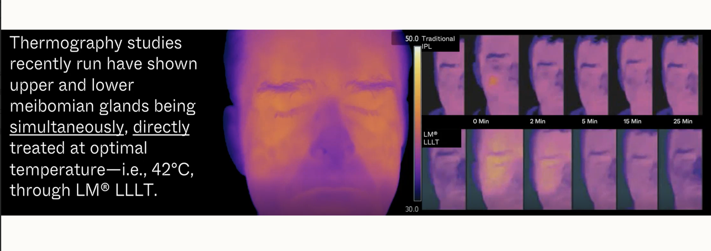 Thermography images comparing upper and lower meibomian glands before and after treatment, showing temperature changes over time.