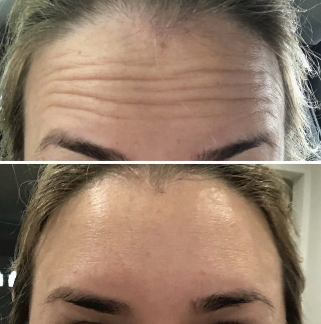 botox - Nicole Renteria.jpeg