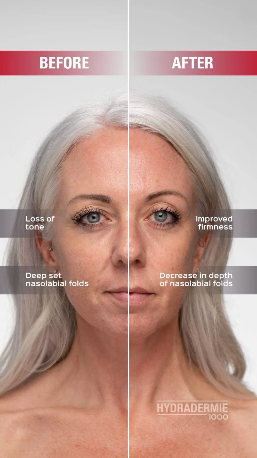 Comparison of a woman's face before and after a skincare treatment, showing improved firmness and decreased nasolabial folds on the right side.