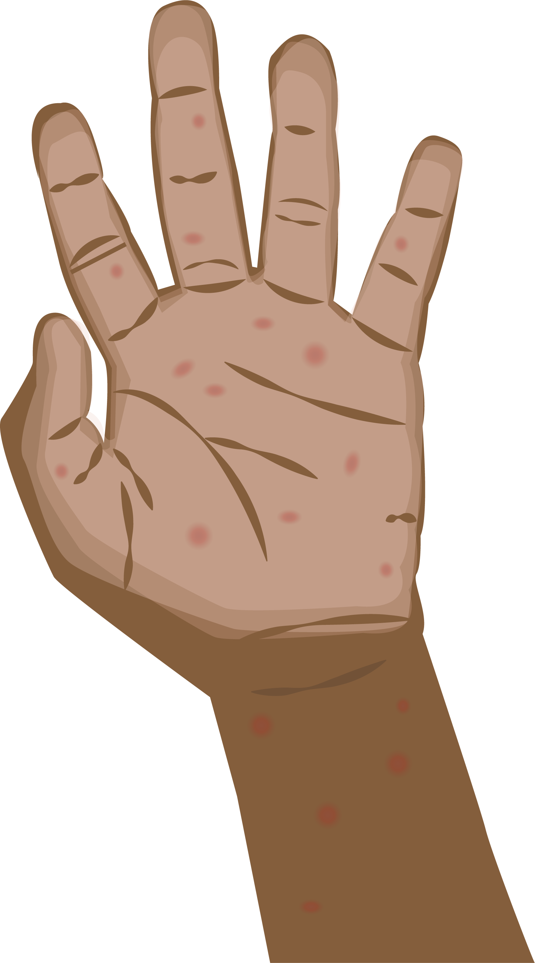 Rash on palm of hand.png