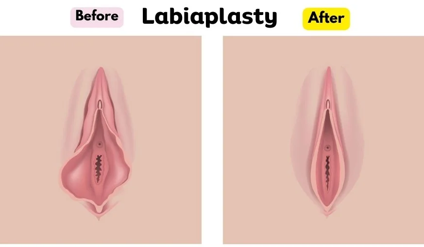 Labiaplasty Before and After Transformations, Costs, and Photos