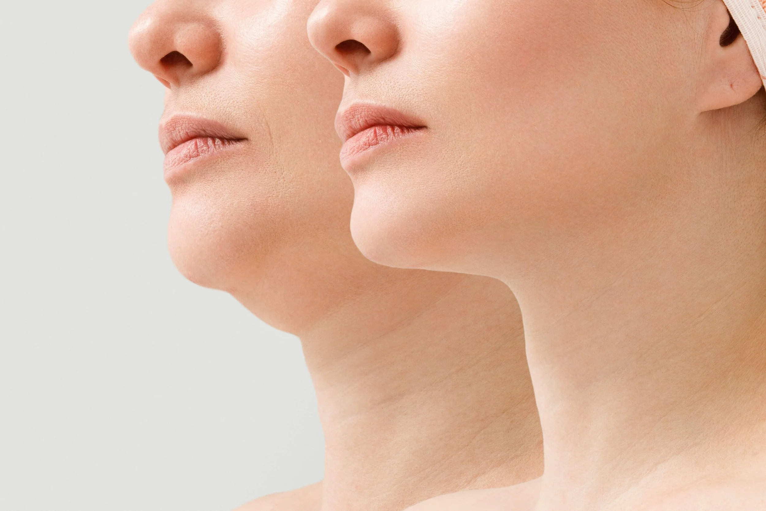 deep plane facelift and necklift