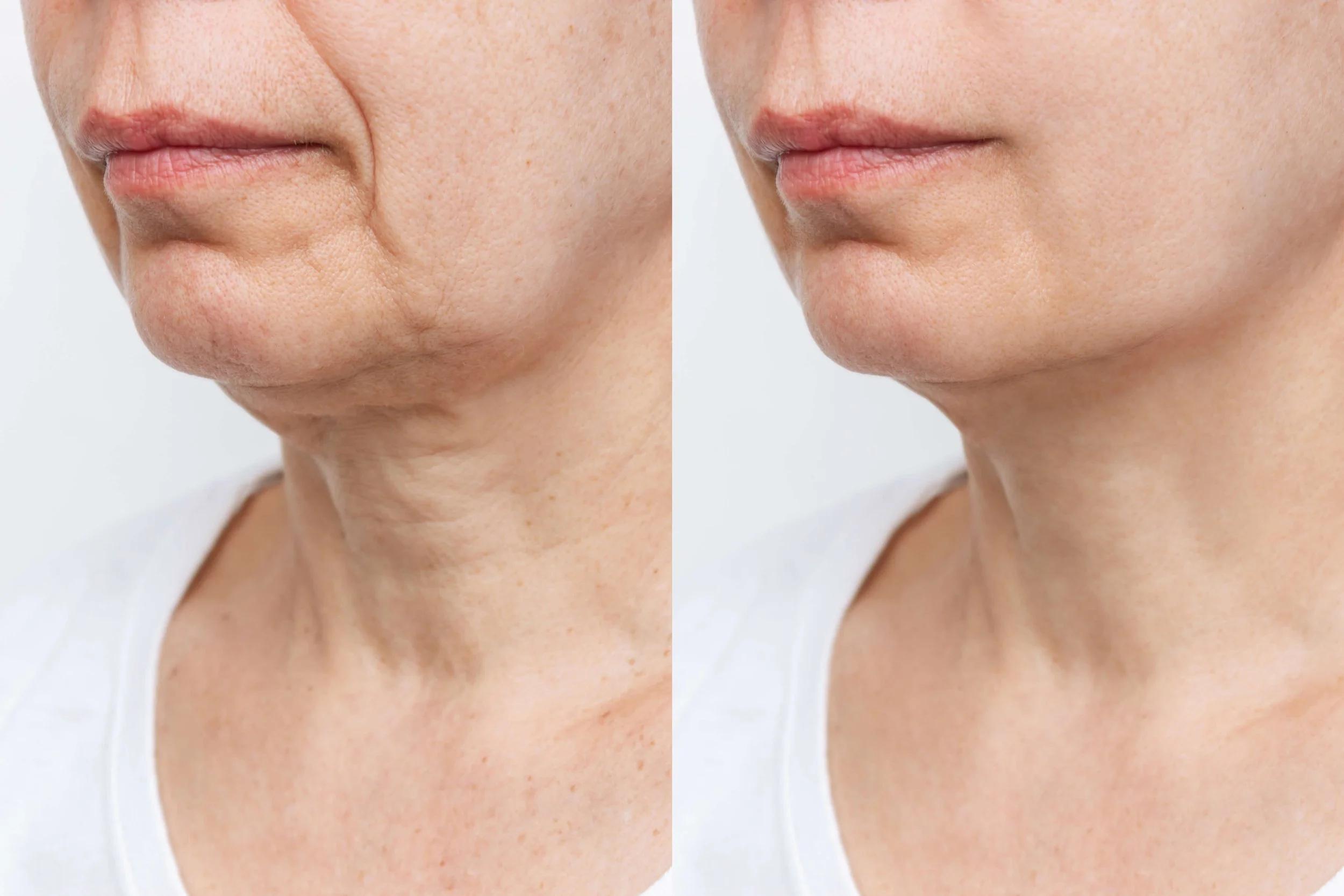 Women side by side facelift results