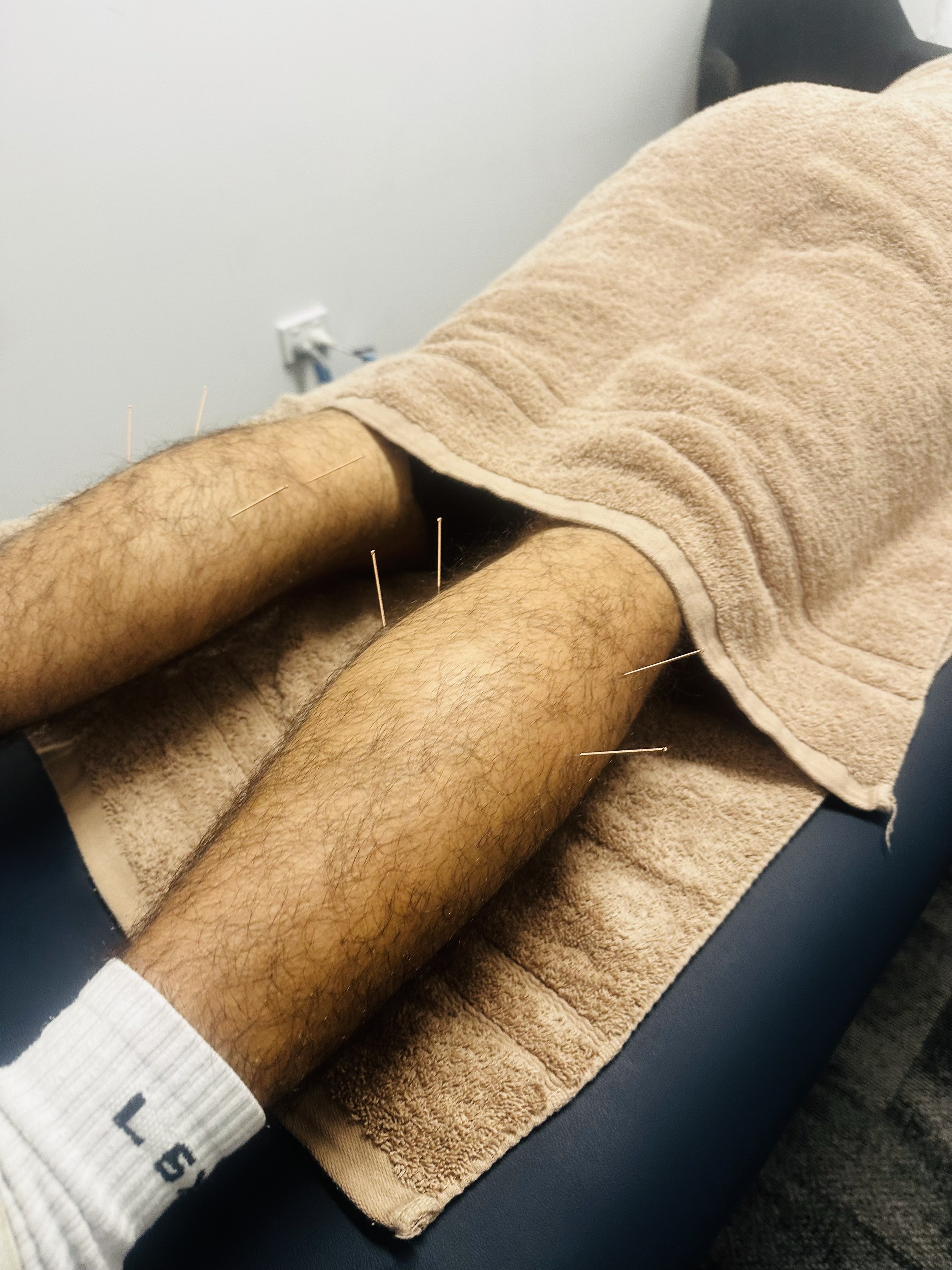 Dry needling performed by an osteopath at Osteo Wellness Studio in Burleigh Waters