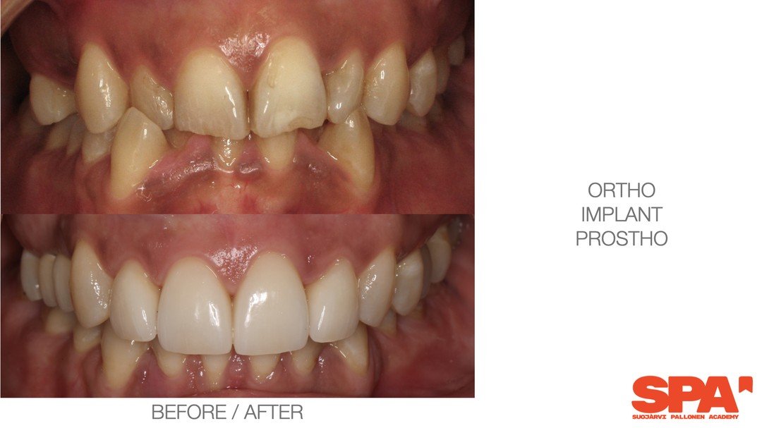 Gotta love the team 🥰

I&acute;m so happy and privileged to be a part of our team. 
Let&acute;s introduce another multi-disciplinary case.

Everything started with ortho.
Implant reg 14 was placed and used as an orthodontic anchor to create space in