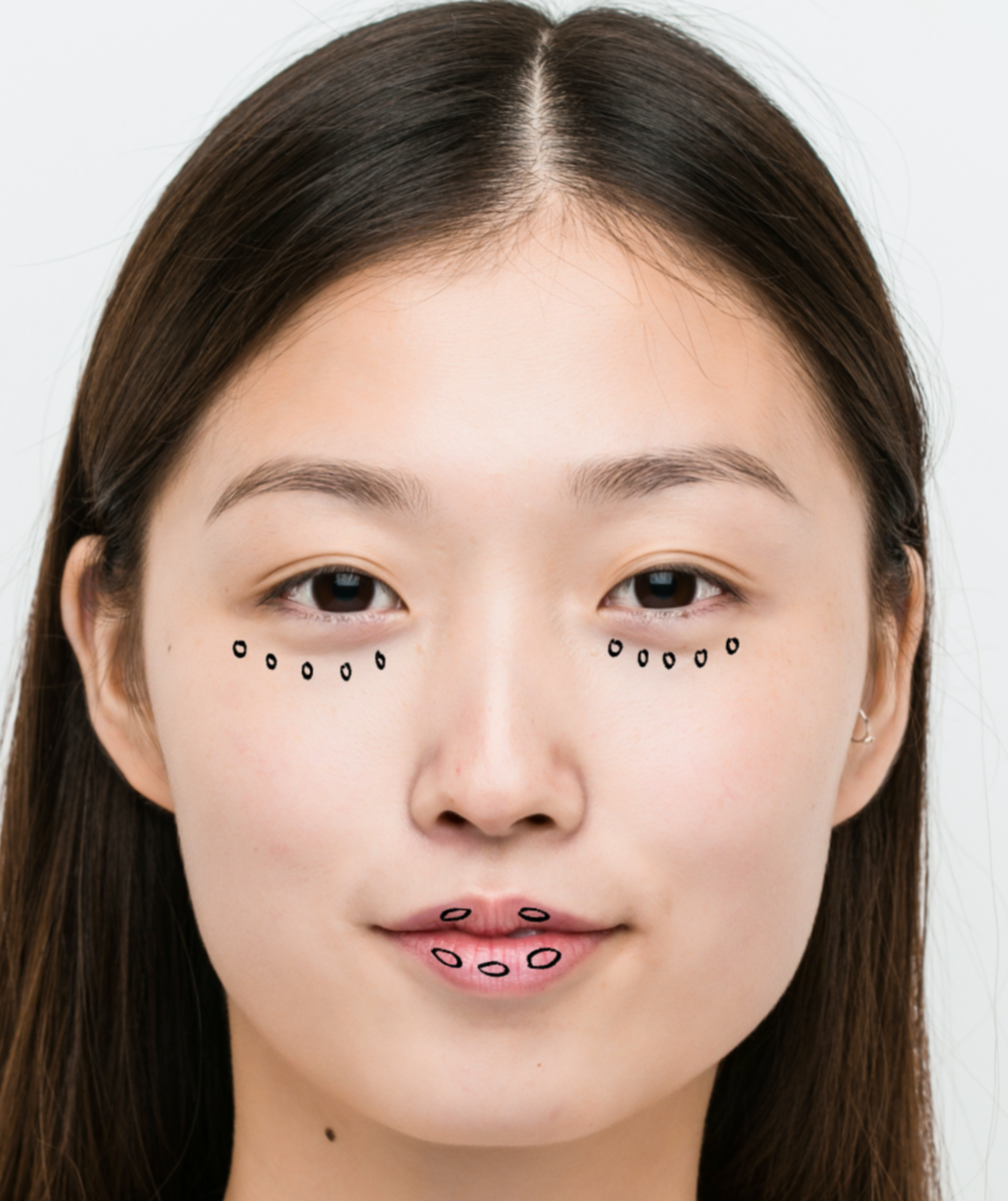 Subtle lip filler treatment using micro-dose dermal filler to refine lip shape, smooth fine lines, and maintain natural-looking results in Denver.