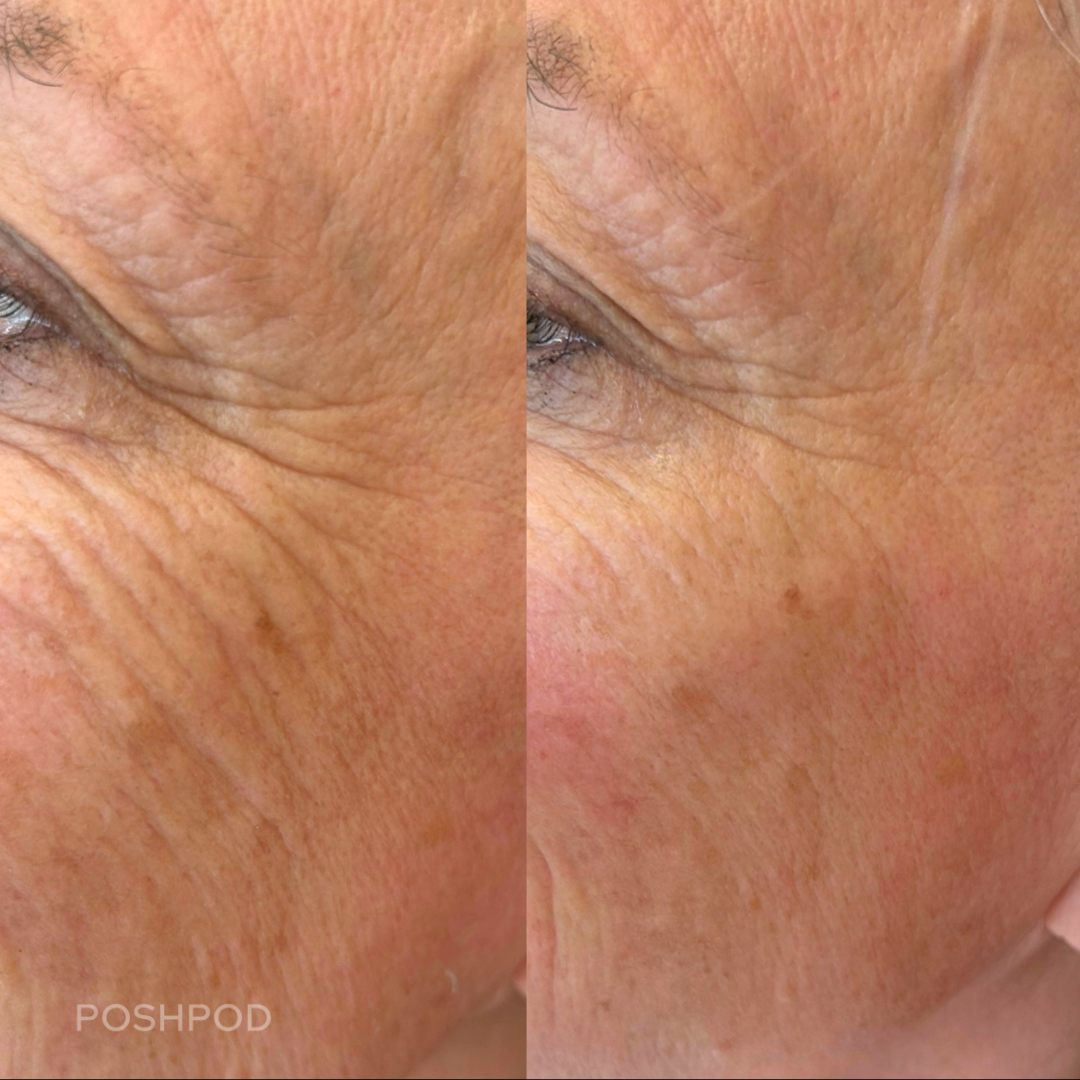 RHA filler for fine lines under eyes and medial cheek Denver Med Spa