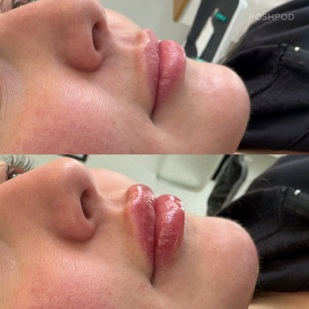 Natural Lip Filler Before and After Photos by Certified Injector Ashley Zhivotovsky Denver